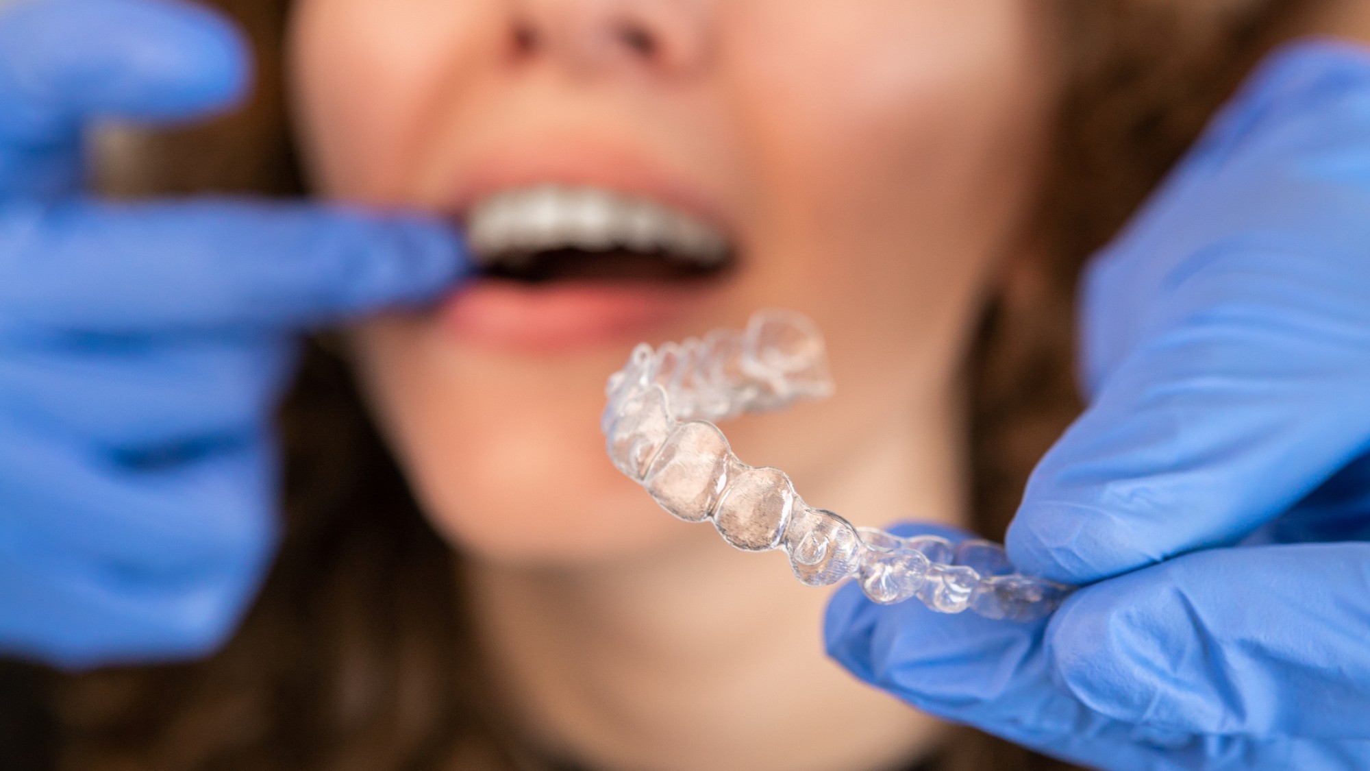 clear aligners & clear braces